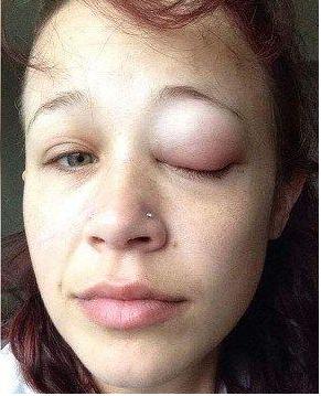 “Fue un error enorme”: el drama de la modelo que se tatuó el ojo y quedó ciega