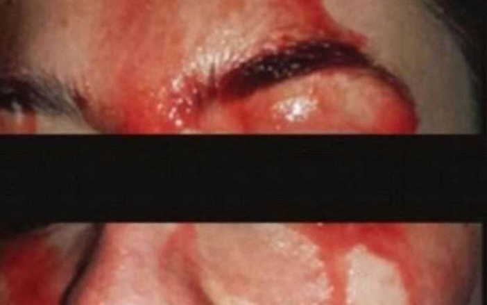 El extraño caso de la joven que suda sangre