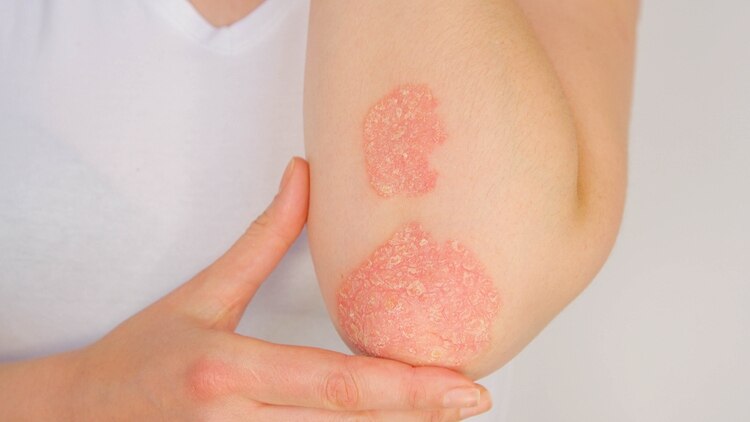 Psoriasis, una enfermedad crónica, sin cura y no contagiosa